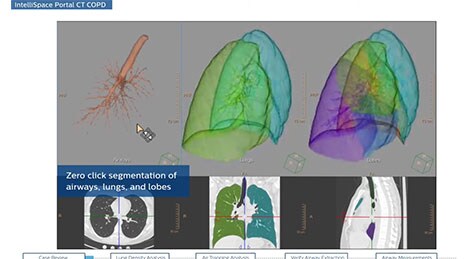 ct copd youtube video thumbnail