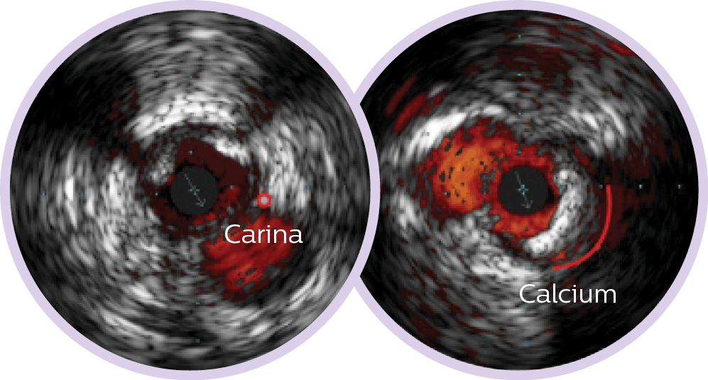 ambiguous angio gram bubble