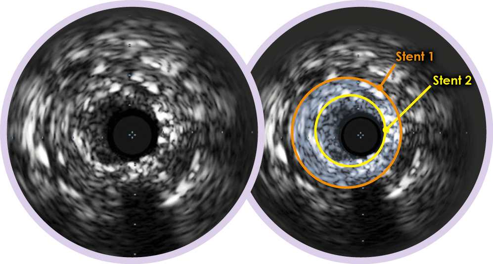 ambiguous angio gram bubble