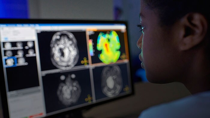 Enhancing brain tumor MRI with APT weighted imaging