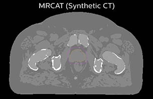 Turku MRCAT synthetic CT case 4