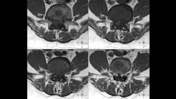 MRI of spondylosis in lumbar spine