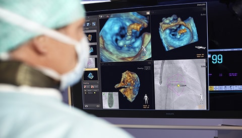 إحداث فرق حقيقي بفضل تقنية التوجيه بالصور المباشرة Philips Live Image Guidance في علاج أمراض القلب الهيكلية  