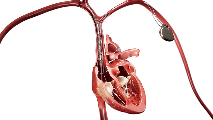 Philips launches new Bridge Plus Occlusion Balloon to help manage rare but life-threatening SVC tears during lead extraction